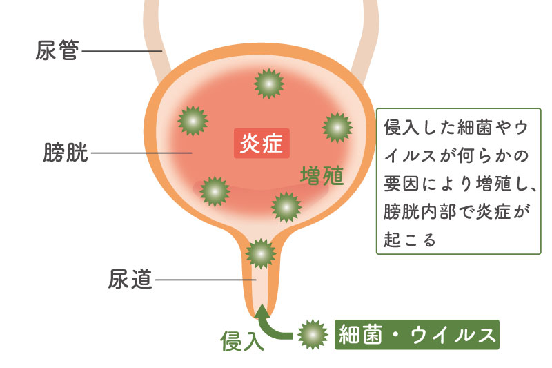 膀胱炎について 最近が侵入し、増殖することで炎症を引き起こす