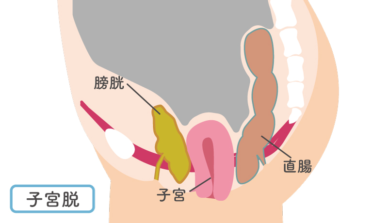 子宮脱