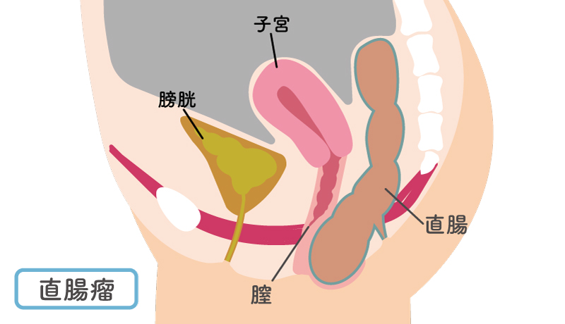 直腸瘤